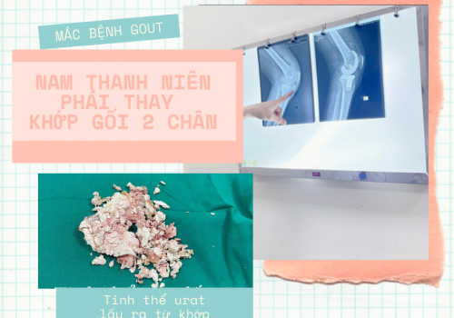 MẮC BỆNH GOUT, NAM THANH NIÊN PHẢI THAY KHỚP GỐI CẢ 2 CHÂN
