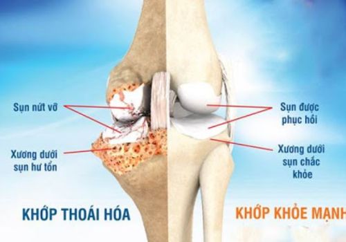 Căn bệnh là nguyên nhân hàng đầu gây tàn tật cho người mắc cơ xương khớp