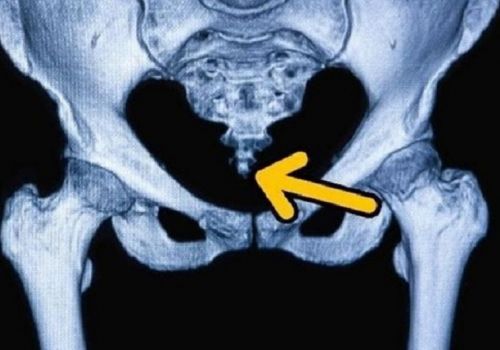 Đau xương cụt: Nguyên nhân, triệu chứng và cách điều trị