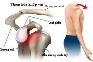Thoái hoá khớp xương vai